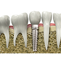 Biomatériaux pour implants