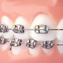 Brackets metálico convencional