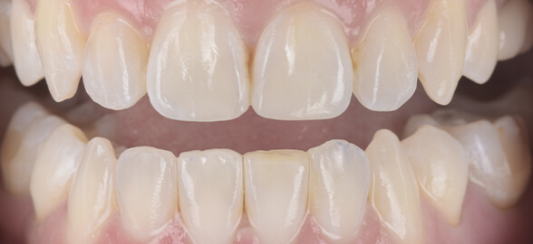 La restauration esthétique post-orthodontique à l'aide d'un composite universel