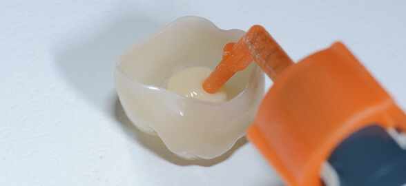 Clinical case: Protocol for the adhesive cementation of posts, abutments and crowns