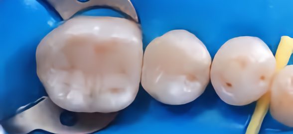 Cimento de hidróxido de cálcio: como funciona e as suas utilizações em revestimento da polpa e endodontia