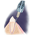 Anestesia Intraligmatica