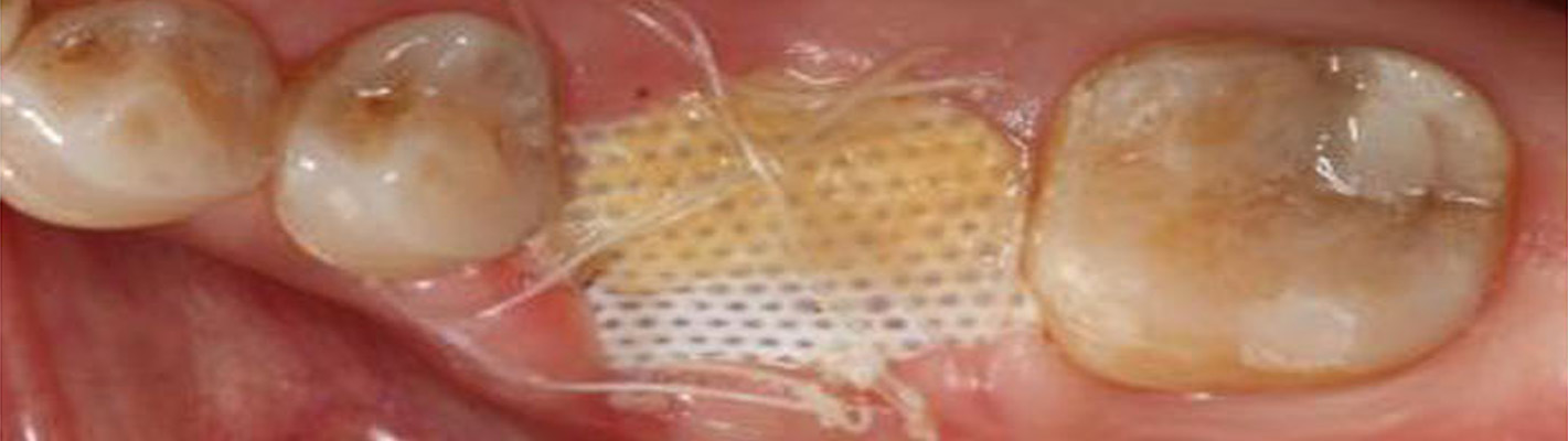 caso clínico membranas PTFE
