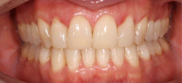 How to improve your dental restorations with heated composite: greater precision, aesthetics and durability
