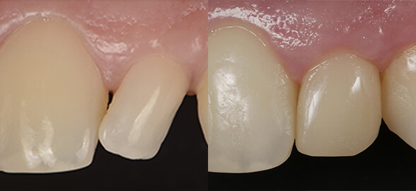 Caso clínico de uma restauração lateral conoide simples