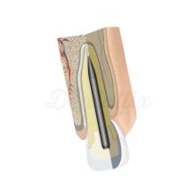 Mirafit Carbon: Threadless Reconstruction Post (6 pieces)