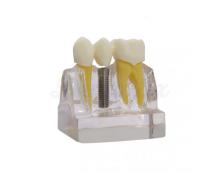 Implant-Bridge demonstration model