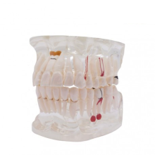 Transparent Typodont with Implant
