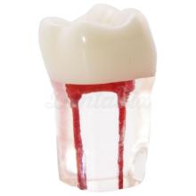 Root Canal Molar for Students