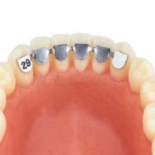 Assortment retainers lingual orthodontics (10pcs)