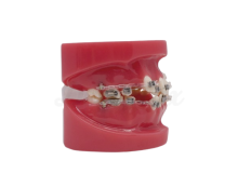 Metallic and Sapphire Brackets Model