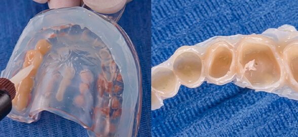 The importance of the temporary phase in complex restorative treatments